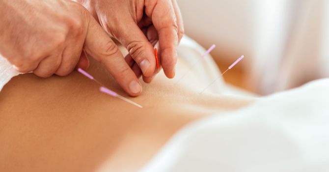 Acupuncture and Dry Needling